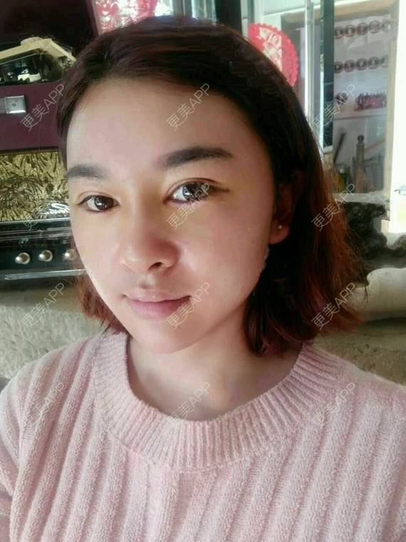 更美 - 金木研CP的全切双眼皮经验 | 全切双眼皮 | 昆明