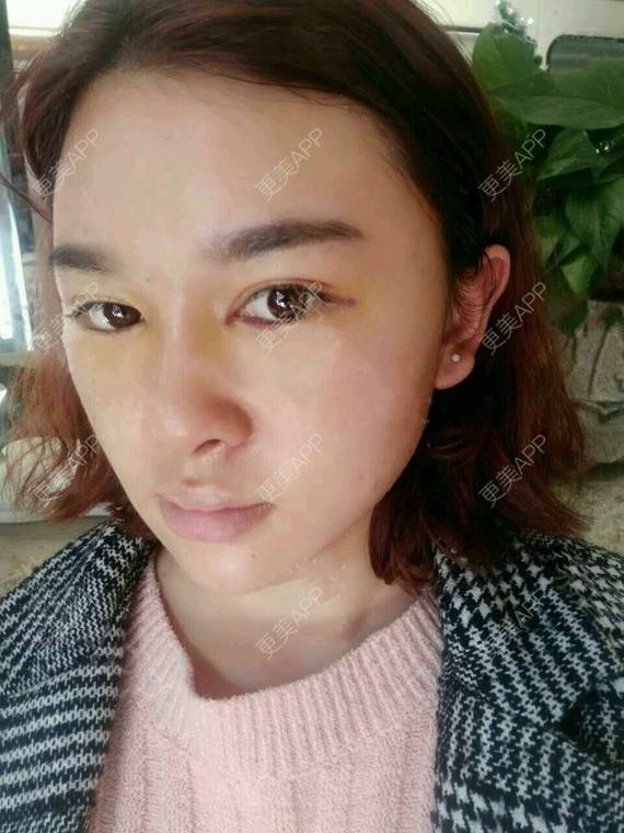 更美 - 金木研CP的全切双眼皮经验 | 全切双眼皮 | 昆明