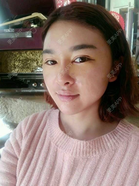 更美 - 金木研CP的全切双眼皮经验 | 全切双眼皮 | 昆明