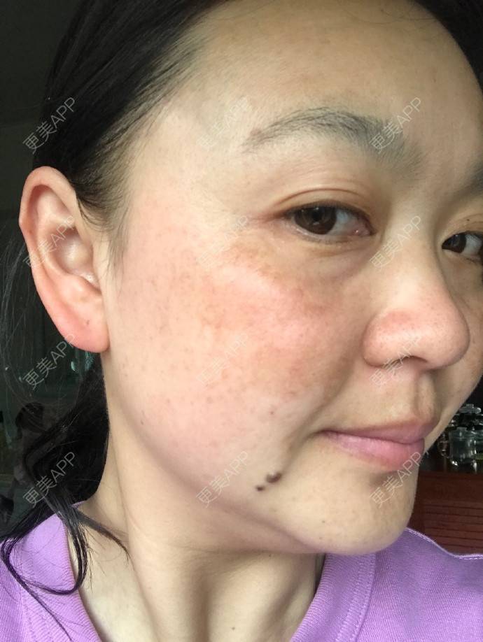 更美 - 更美用户zsctx2aojd的皮秒激光日记 | 皮秒激光 | 视频日记