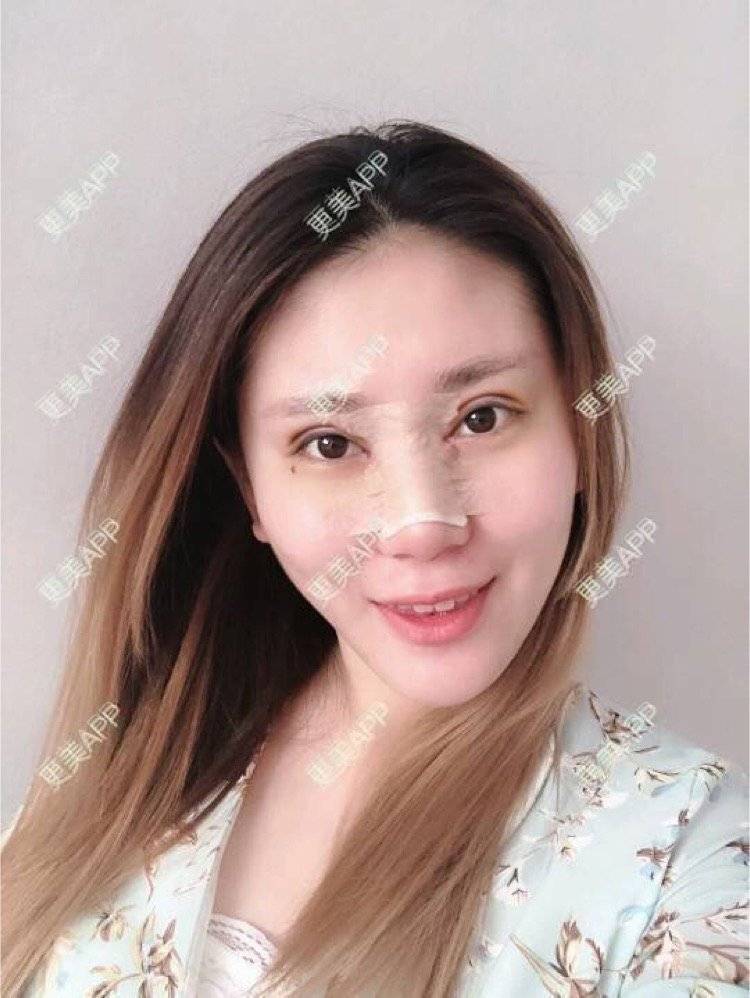 更美 - 圈圈子的鼻部多项经验 | 丰胸（隆胸） | 武汉 | 埋线双眼皮 | 眼部多项 | 上海 | 济南 | 全切双眼皮 | 鼻部多项 | 长沙 | 吸脂 | 南京 | 玻尿酸 | 祛斑祛色素 | 自体脂肪隆胸 | 埋线提升 | 双下巴吸脂 | 合肥 | 北京 | 兰州 | 哈尔滨 | 除皱瘦脸 | 皮秒激光 | 女性私密 | 果酸焕肤 | 东莞