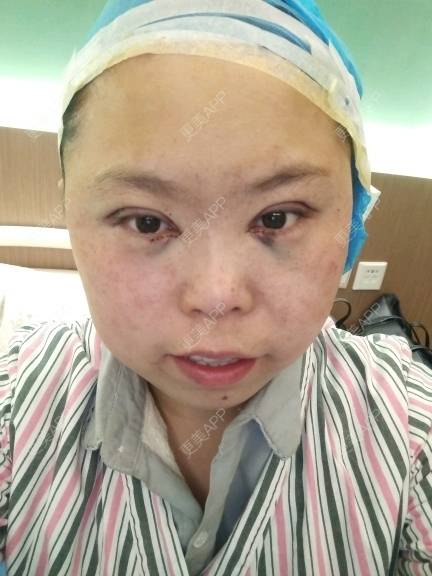 更美 - 更美用户rAtXBlqCtE的眼部多项经验 | 美白套餐 | 上海 | 全切双眼皮 | 鼻部多项 | 长沙 | 沈阳 | 深圳 | 吸脂 | 玻尿酸 | 成都 | 杭州 | 激光脱毛 | 郑州 | 埋线提升 | 肋软骨隆鼻 | 注射溶脂瘦脸 | 眼部多项 | 除皱瘦脸 | 淡化皱纹 | 皮秒激光 | 玻尿酸下巴 | 东莞