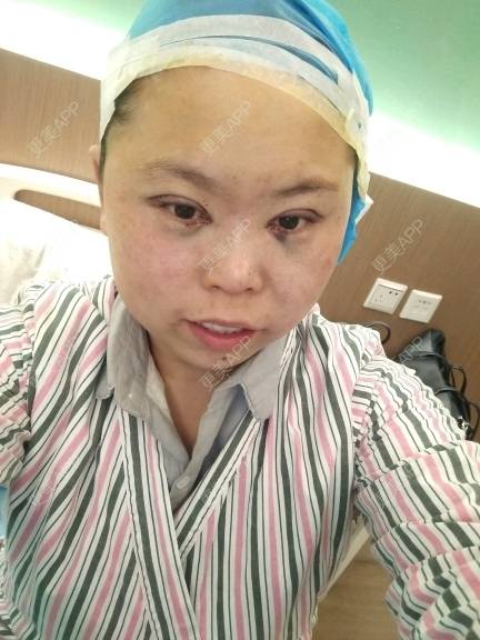 更美 - 更美用户rAtXBlqCtE的眼部多项经验 | 美白套餐 | 上海 | 全切双眼皮 | 鼻部多项 | 长沙 | 沈阳 | 深圳 | 吸脂 | 玻尿酸 | 成都 | 杭州 | 激光脱毛 | 郑州 | 埋线提升 | 肋软骨隆鼻 | 注射溶脂瘦脸 | 眼部多项 | 除皱瘦脸 | 淡化皱纹 | 皮秒激光 | 玻尿酸下巴 | 东莞
