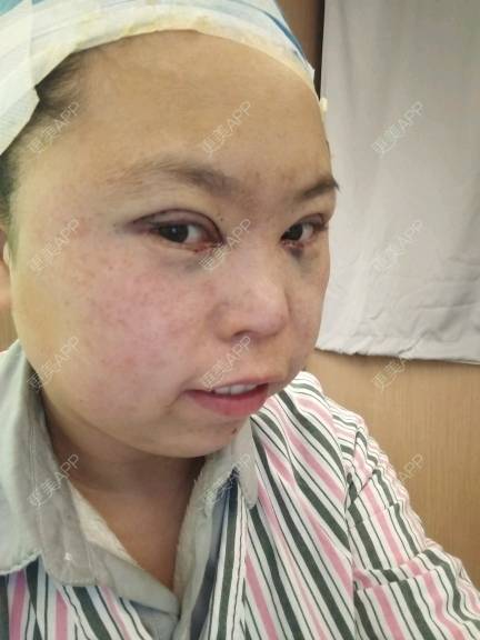 更美 - 更美用户rAtXBlqCtE的眼部多项经验 | 美白套餐 | 上海 | 全切双眼皮 | 鼻部多项 | 长沙 | 沈阳 | 深圳 | 吸脂 | 玻尿酸 | 成都 | 杭州 | 激光脱毛 | 郑州 | 埋线提升 | 肋软骨隆鼻 | 注射溶脂瘦脸 | 眼部多项 | 除皱瘦脸 | 淡化皱纹 | 皮秒激光 | 玻尿酸下巴 | 东莞