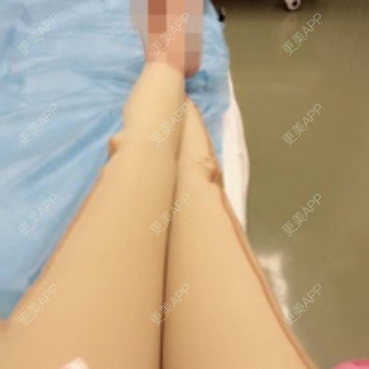 更美 - 更美用户kfFP2Ku1YP的射频溶脂经验 | 注射溶脂瘦脸 | 假体丰臀 | 隆鼻 | 吸脂 | 玻尿酸 | 切眉 | 射频溶脂 | 私处漂红 | 除皱瘦脸 | 埋线提升 | 皮秒激光 | 上海