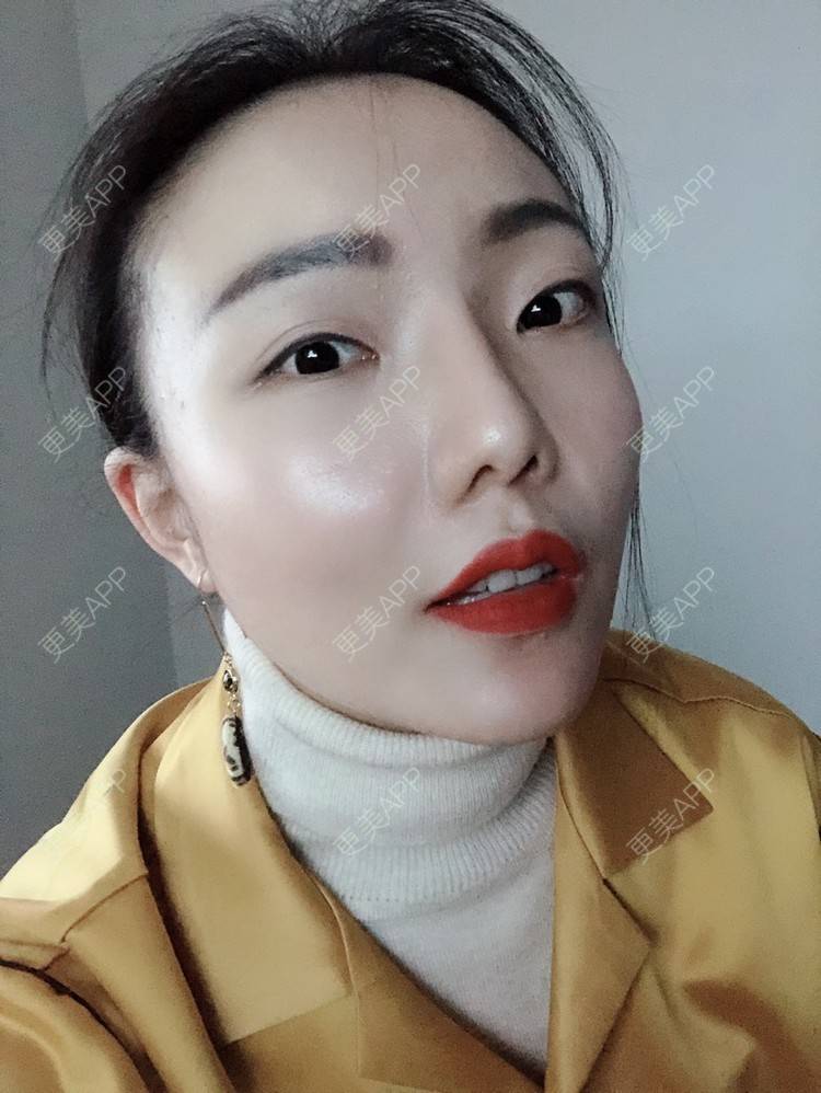 更美 - 更美用户HktsdssB56的牙贴面经验 | 成都 | 牙贴面 | 牙齿瓷贴面