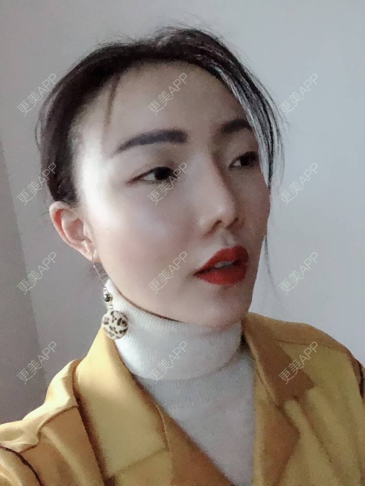 更美 - 更美用户HktsdssB56的牙贴面经验 | 成都 | 牙贴面 | 牙齿瓷贴面