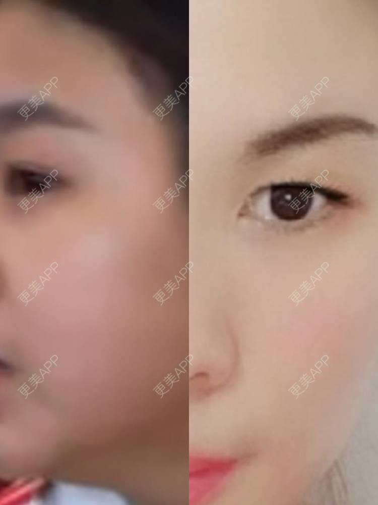 更美 - 爱情@符号的超声提升经验 | 超声提升 | 苏州