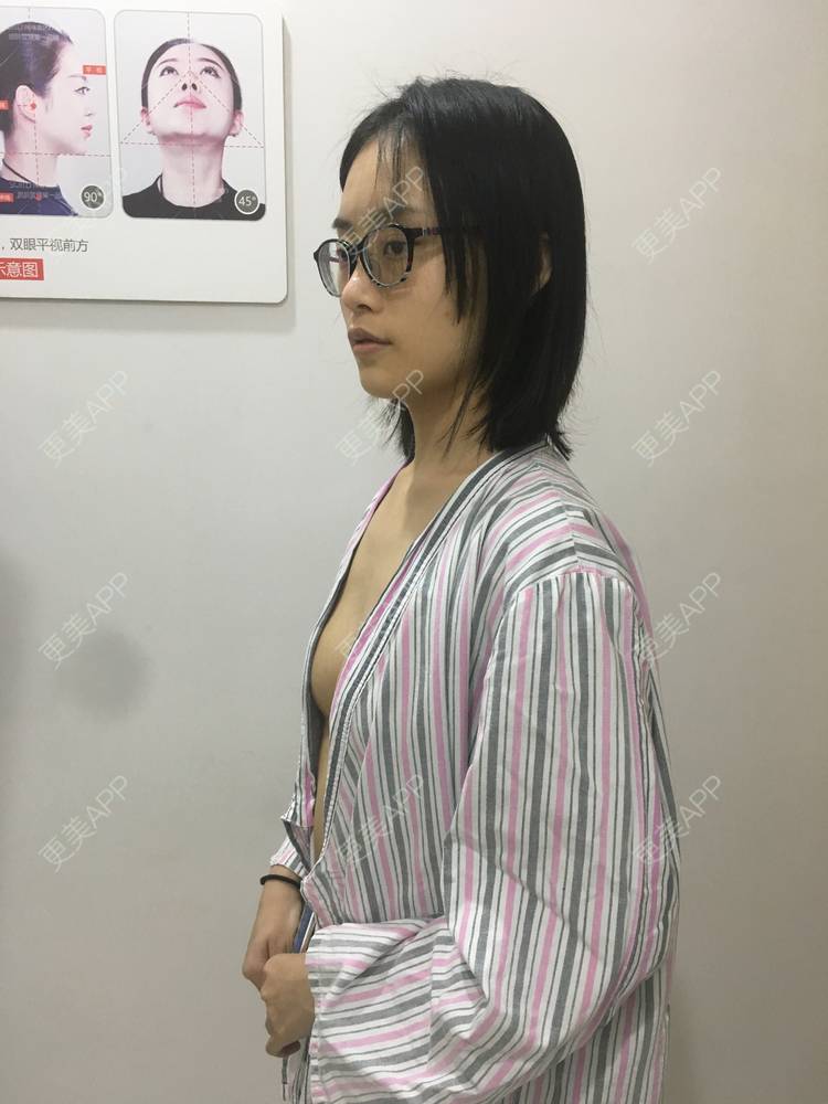 丰胸(隆胸) | 假体隆胸 | 自体脂肪隆胸 | 胶原蛋白丰胸 | 玻尿酸隆胸