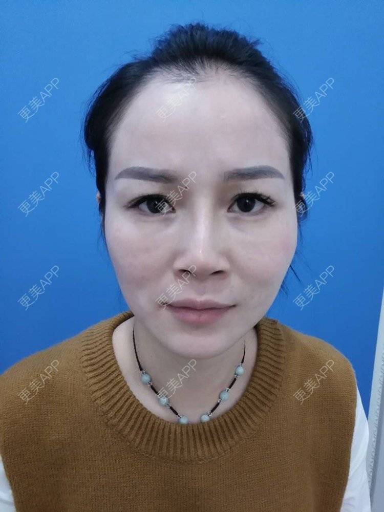 更美 - 祢的美丽/我的职责的全切双眼皮经验 | 肋软骨隆鼻 | 全切双眼皮 | 开内眼角 | 开外眼角 | 内切去眼袋 | 上海