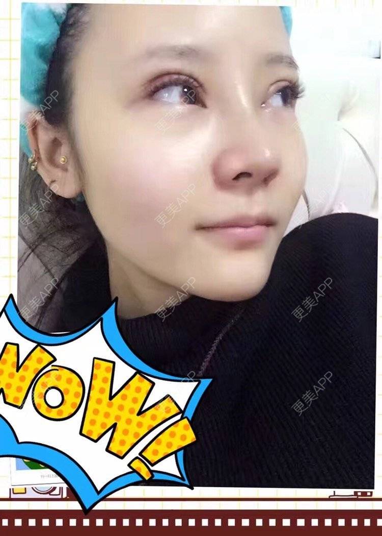 更美 - 祢的美丽/我的职责的全切双眼皮经验 | 肋软骨隆鼻 | 全切双眼皮 | 开内眼角 | 开外眼角 | 内切去眼袋 | 上海