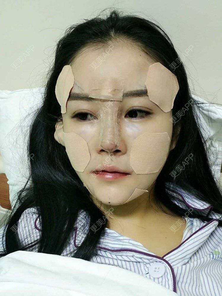 更美 - 祢的美丽/我的职责的全切双眼皮经验 | 肋软骨隆鼻 | 全切双眼皮 | 开内眼角 | 开外眼角 | 内切去眼袋 | 上海