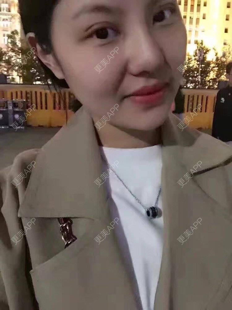 更美 - 祢的美丽/我的职责的全切双眼皮经验 | 肋软骨隆鼻 | 全切双眼皮 | 开内眼角 | 开外眼角 | 内切去眼袋 | 上海