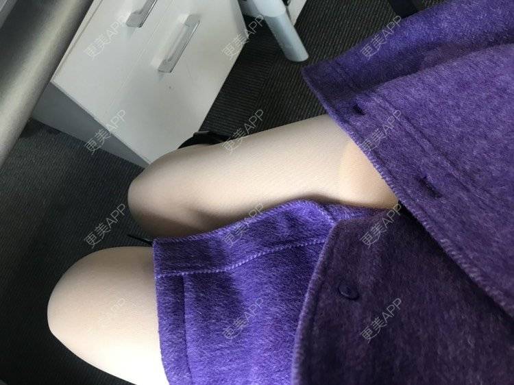 更美 - 请叫我小花的吸脂瘦大腿经验 | 吸脂瘦大腿 | 北京