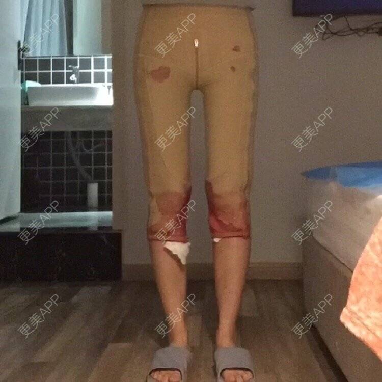 更美 - ❤️尼坤的腰腹吸脂经验 | 武汉 | 自体脂肪丰面颊 | 吸脂瘦脸 | 唇形 | 上海 | 祛眼袋 | 假体隆胸 | 冷光美白 | 鼻部多项 | 长沙 | 广州 | 沈阳 | 深圳 | 吸脂 | 南京 | 腰腹吸脂 | 西安 | 重庆 | 除皱瘦脸 | 热玛吉 | 皮秒激光 | 玻尿酸 | 鼻翼缩小 | 东莞