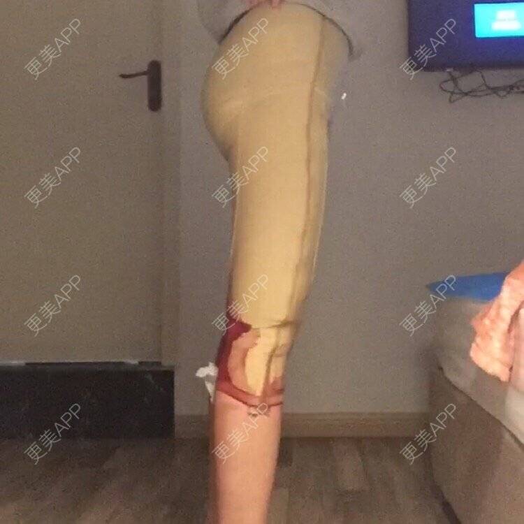 更美 - ❤️尼坤的腰腹吸脂经验 | 武汉 | 自体脂肪丰面颊 | 吸脂瘦脸 | 唇形 | 上海 | 祛眼袋 | 假体隆胸 | 冷光美白 | 鼻部多项 | 长沙 | 广州 | 沈阳 | 深圳 | 吸脂 | 南京 | 腰腹吸脂 | 西安 | 重庆 | 除皱瘦脸 | 热玛吉 | 皮秒激光 | 玻尿酸 | 鼻翼缩小 | 东莞