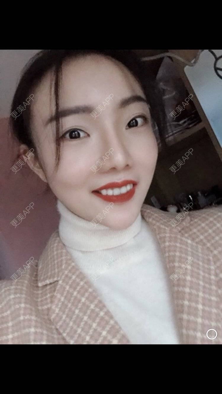 更美 - 更美用户HktsdssB56的牙贴面经验 | 牙齿瓷贴面 | 成都 | 牙贴面