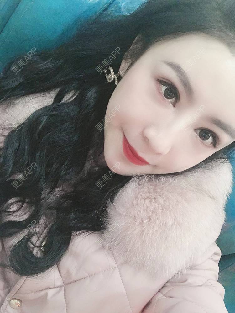 更美 - 卡门小妖精，的玻尿酸卧蚕经验 | 玻尿酸卧蚕 | 重庆 | 自体脂肪丰卧蚕 | 真皮丰卧蚕 | 双眼皮修复 | 眼部多项