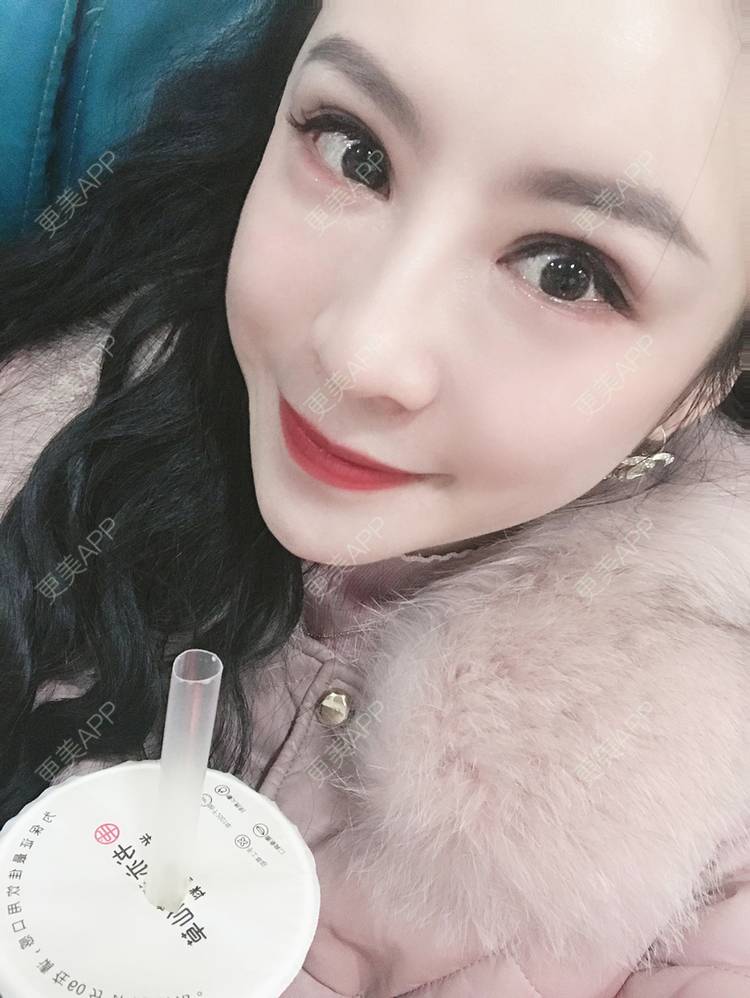 更美 - 卡门小妖精，的玻尿酸卧蚕经验 | 玻尿酸卧蚕 | 重庆 | 自体脂肪丰卧蚕 | 真皮丰卧蚕 | 双眼皮修复 | 眼部多项
