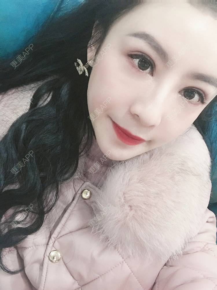 更美 - 卡门小妖精，的玻尿酸卧蚕经验 | 玻尿酸卧蚕 | 重庆 | 自体脂肪丰卧蚕 | 真皮丰卧蚕 | 双眼皮修复 | 眼部多项