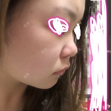 鼻翼