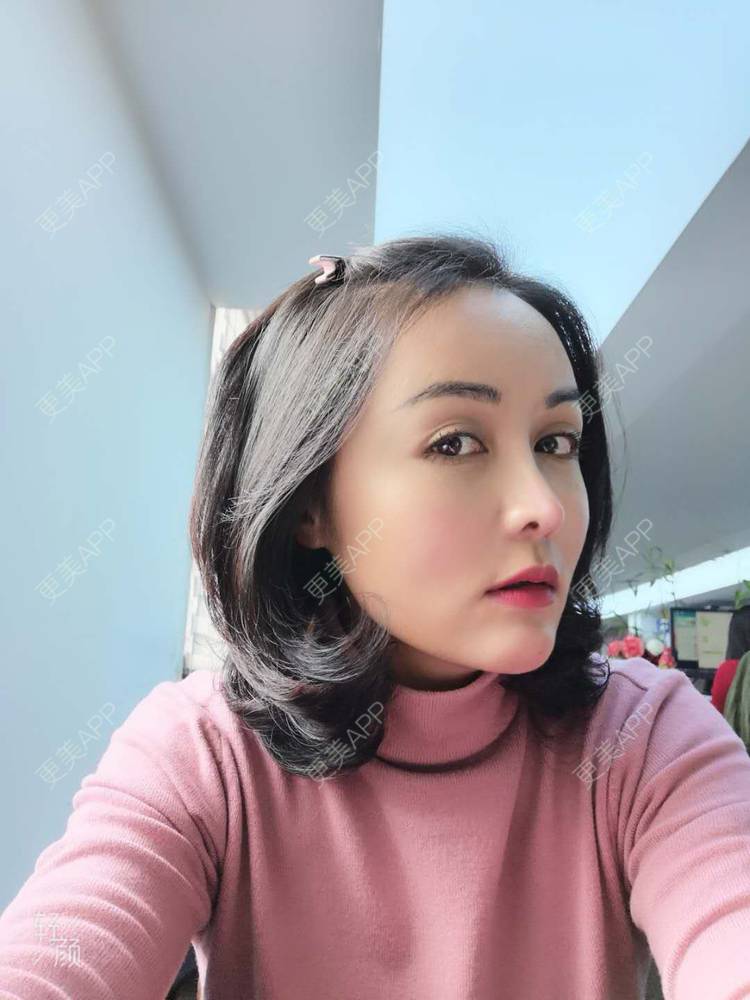 更美 - 瘦不了肿么办的自体脂肪全面部填充经验 | 自体脂肪丰额头 | 自体脂肪丰面颊 | 自体脂肪丰苹果肌 | 自体脂肪填充泪沟 | 丰胸（隆胸） | 自体脂肪垫下巴 | 自体脂肪丰太阳穴 | 假体隆胸 | 自体脂肪隆胸 | 重庆 | 自体脂肪全面部填充