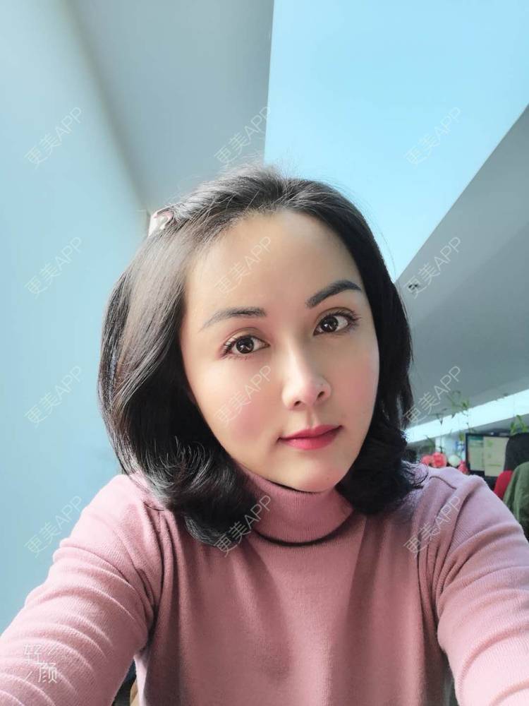 更美 - 瘦不了肿么办的自体脂肪全面部填充经验 | 自体脂肪丰额头 | 自体脂肪丰面颊 | 自体脂肪丰苹果肌 | 自体脂肪填充泪沟 | 丰胸（隆胸） | 自体脂肪垫下巴 | 自体脂肪丰太阳穴 | 假体隆胸 | 自体脂肪隆胸 | 重庆 | 自体脂肪全面部填充