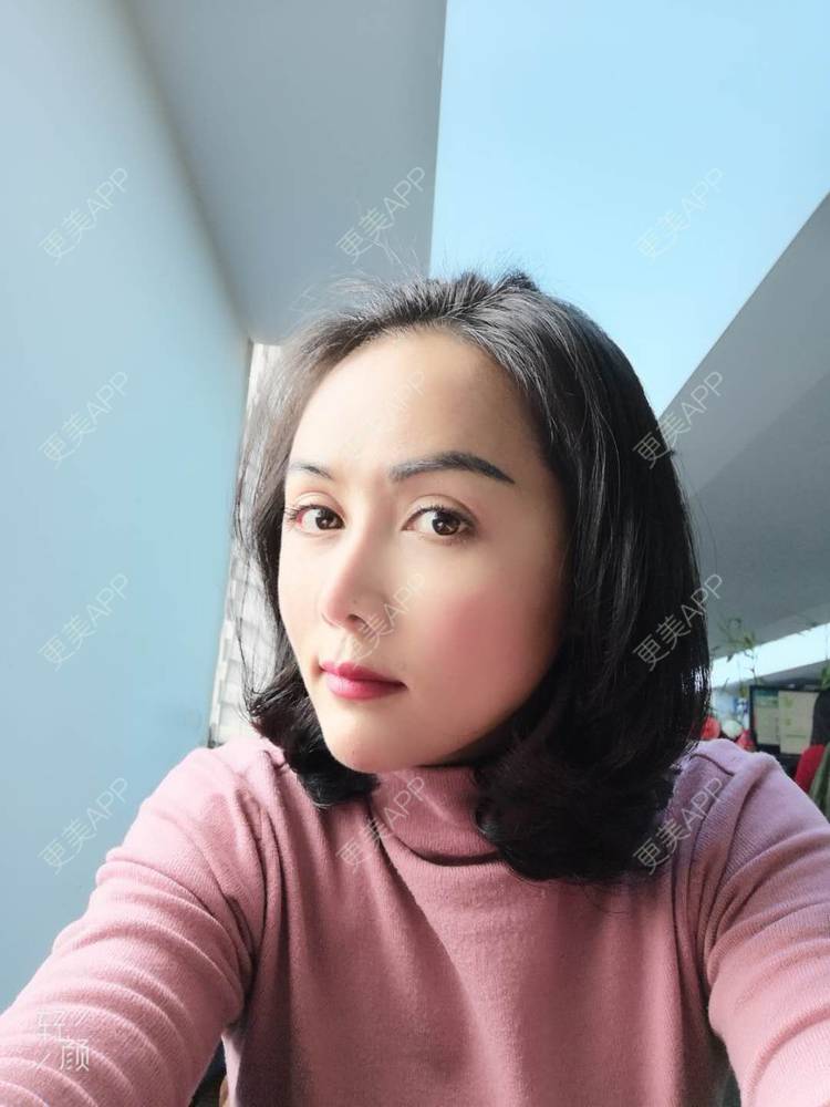 更美 - 瘦不了肿么办的自体脂肪全面部填充经验 | 自体脂肪丰额头 | 自体脂肪丰面颊 | 自体脂肪丰苹果肌 | 自体脂肪填充泪沟 | 丰胸（隆胸） | 自体脂肪垫下巴 | 自体脂肪丰太阳穴 | 假体隆胸 | 自体脂肪隆胸 | 重庆 | 自体脂肪全面部填充