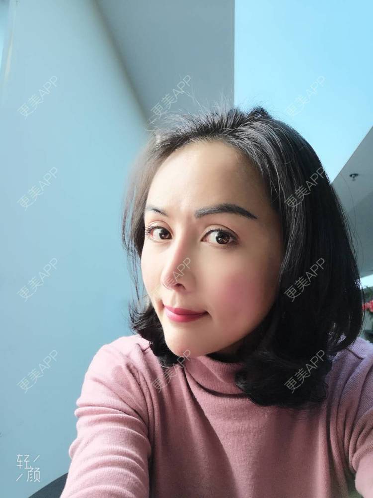 更美 - 瘦不了肿么办的自体脂肪全面部填充经验 | 自体脂肪丰额头 | 自体脂肪丰面颊 | 自体脂肪丰苹果肌 | 自体脂肪填充泪沟 | 丰胸（隆胸） | 自体脂肪垫下巴 | 自体脂肪丰太阳穴 | 假体隆胸 | 自体脂肪隆胸 | 重庆 | 自体脂肪全面部填充