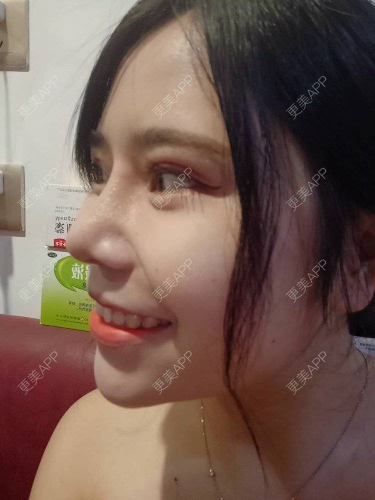 更美 - 更美用户i4TVl9s5yR的鼻部多项经验 | 鼻部多项 | 玻尿酸面颊 | 上海