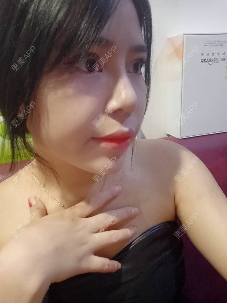 更美 - 更美用户i4TVl9s5yR的鼻部多项经验 | 鼻部多项 | 玻尿酸面颊 | 上海