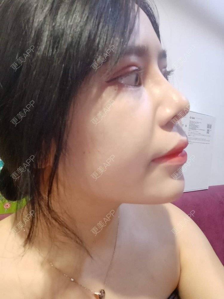 更美 - 更美用户i4TVl9s5yR的鼻部多项经验 | 鼻部多项 | 玻尿酸面颊 | 上海