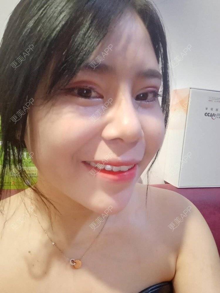 更美 - 更美用户i4TVl9s5yR的鼻部多项经验 | 鼻部多项 | 玻尿酸面颊 | 上海
