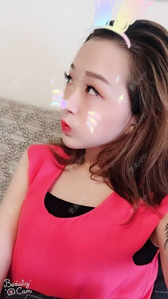更美 - 更美用户lCgZFpup1y的人工骨垫下巴经验 | 人工骨垫下巴 | 上海