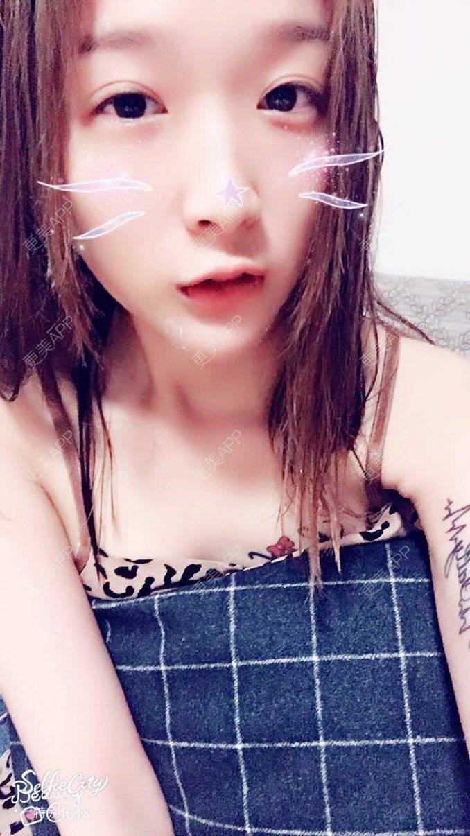 更美 - 更美用户lCgZFpup1y的人工骨垫下巴经验 | 人工骨垫下巴 | 上海