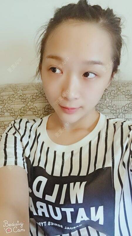 更美 - 更美用户lCgZFpup1y的人工骨垫下巴经验 | 人工骨垫下巴 | 上海