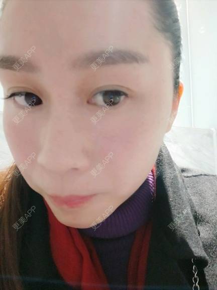 更美 - 大人.o的水光项目经验 | 成都 | 自体脂肪面部填充 | 水光项目 | 北京 | 深圳 | 下颌角 | 隆鼻 | 南京 | 假体隆胸 | 除皱瘦脸 | 长沙 | 牙贴面 | 玻尿酸 | 吸脂 | 东莞 | 鼻部综合