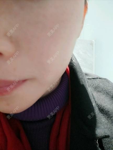 更美 - 大人.o的水光项目经验 | 成都 | 自体脂肪面部填充 | 水光项目 | 北京 | 深圳 | 下颌角 | 隆鼻 | 南京 | 假体隆胸 | 除皱瘦脸 | 长沙 | 牙贴面 | 玻尿酸 | 吸脂 | 东莞 | 鼻部综合