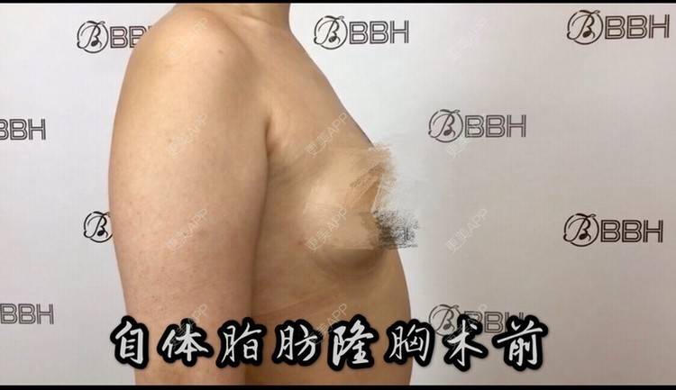 更美 - 昆明日韩BBH🏥的自体脂肪隆胸经验 | 自体脂肪隆胸 | 昆明