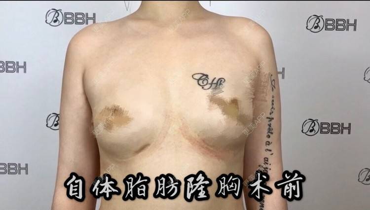 更美 - 昆明日韩BBH🏥的自体脂肪隆胸经验 | 自体脂肪隆胸 | 昆明