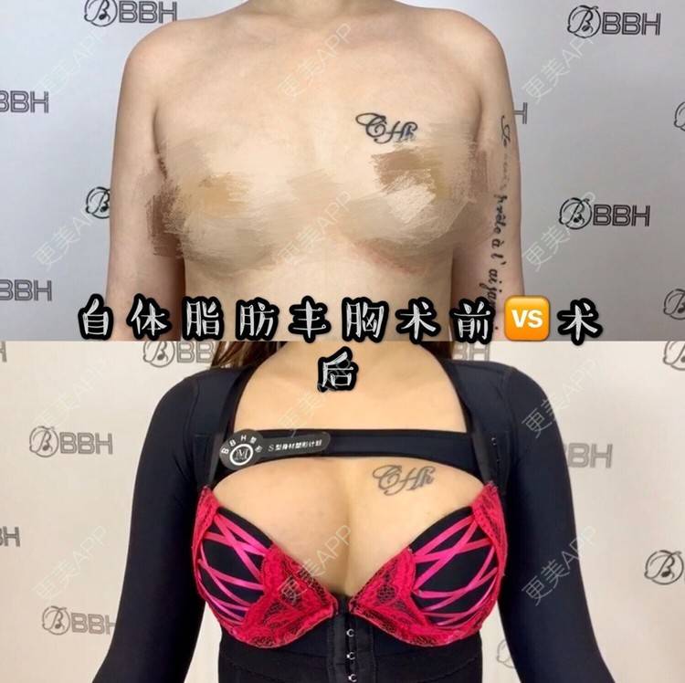 更美 - 昆明日韩BBH🏥的自体脂肪隆胸经验 | 自体脂肪隆胸 | 昆明