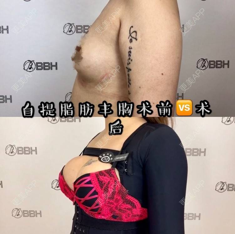 更美 - 昆明日韩BBH🏥的自体脂肪隆胸经验 | 自体脂肪隆胸 | 昆明
