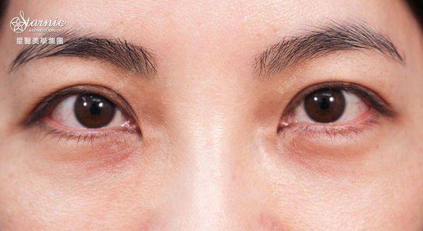 夕夕的眼皮下垂矫正日记