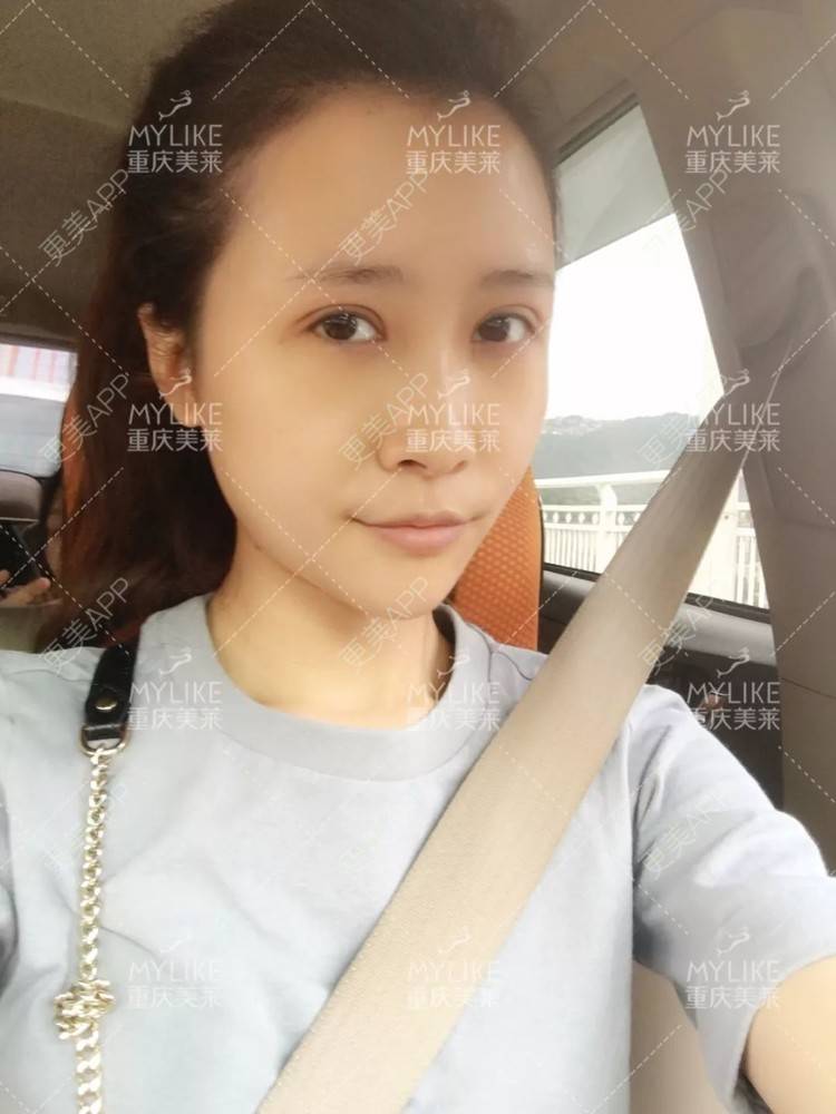 更美 - 重庆美莱整形美容医院的祛眼袋经验 | 祛眼袋