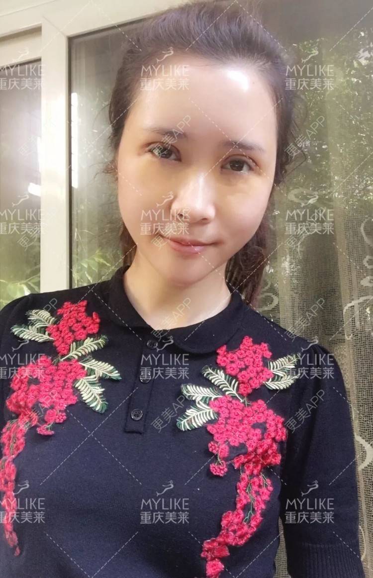更美 - 重庆美莱整形美容医院的祛眼袋经验 | 祛眼袋