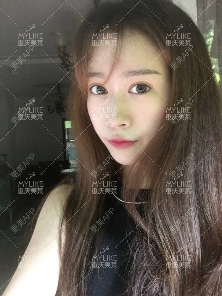 更美 - 重庆美莱整形美容医院的祛眼袋经验 | 祛眼袋
