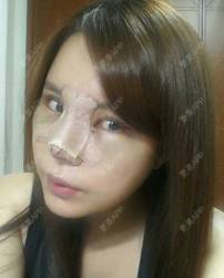 更美 - 更美用户ejJuxMDpUo的膨体隆鼻经验 | 膨体隆鼻 | 莆田