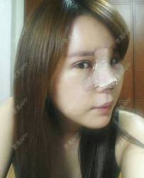 更美 - 更美用户ejJuxMDpUo的膨体隆鼻经验 | 膨体隆鼻 | 莆田