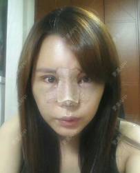 更美 - 更美用户ejJuxMDpUo的膨体隆鼻经验 | 膨体隆鼻 | 莆田