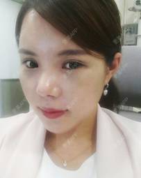 更美 - 更美用户ejJuxMDpUo的膨体隆鼻经验 | 膨体隆鼻 | 莆田